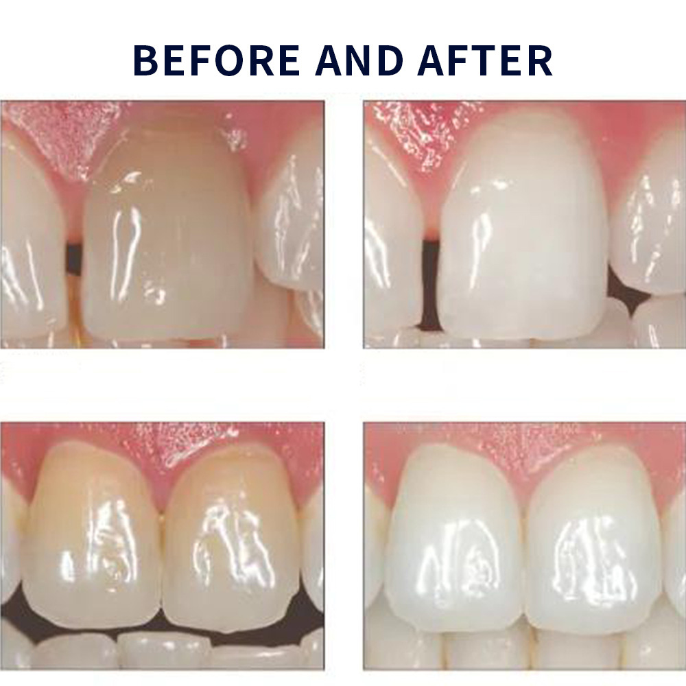 Opalescencia blanqueadora 20%  - Teeth Whitening Remedies reseña y precio