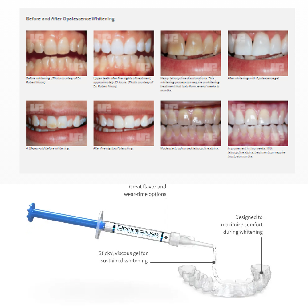 Opalescencia blanqueadora 20%  - Teeth Whitening Remedies reseña y precio