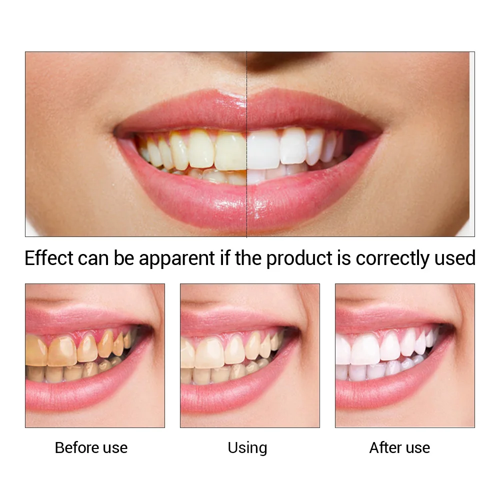 FTEENPLY-esencia para blanquea - Teeth Whitening Remedies reseña y precio