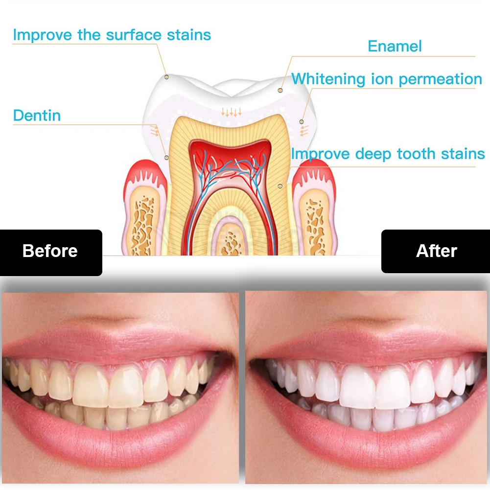 Kit de blanqueamiento Dental M - Teeth Whitening Remedies reseña y precio